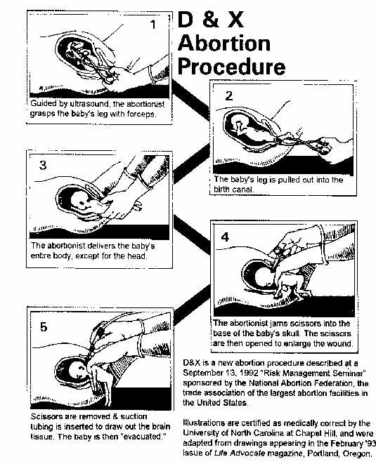 Partial Birth Abortion