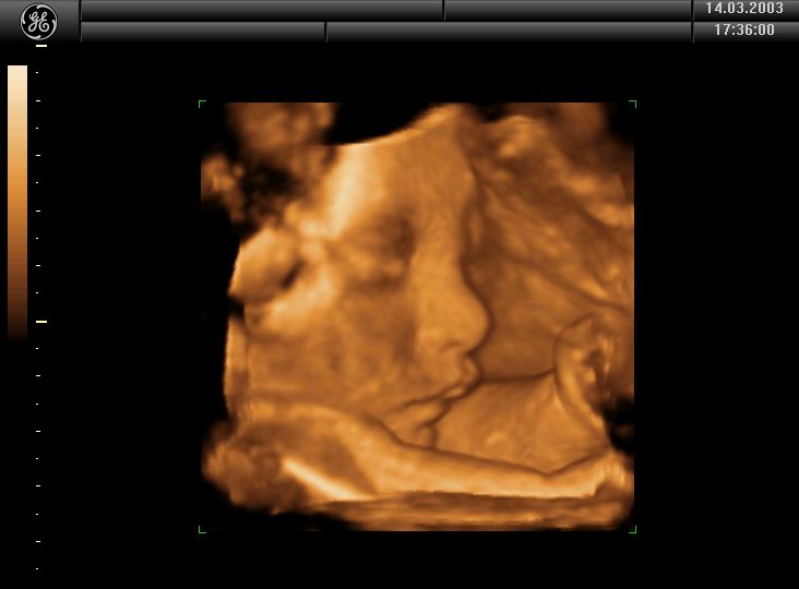 4D Ultrasound, Sono view