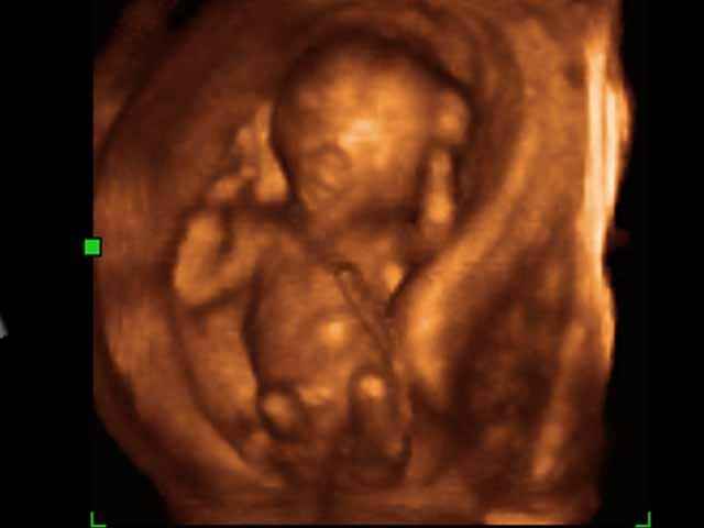 Sonogram, 1st trimester