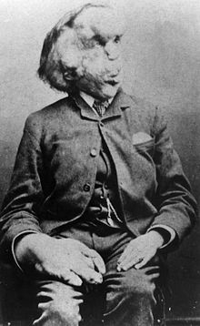 Joseph Merrick